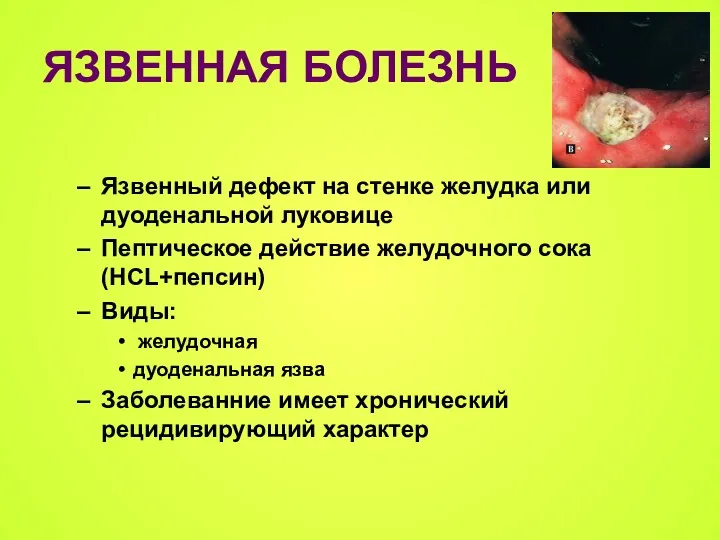 ЯЗВЕННАЯ БОЛЕЗНЬ Язвенный дефект на стенке желудка или дуоденальной луковице