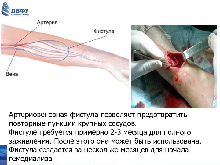 Артериовенозная фистула позволяет предотвратить повторные пункции крупных сосудов. Фистуле требуется