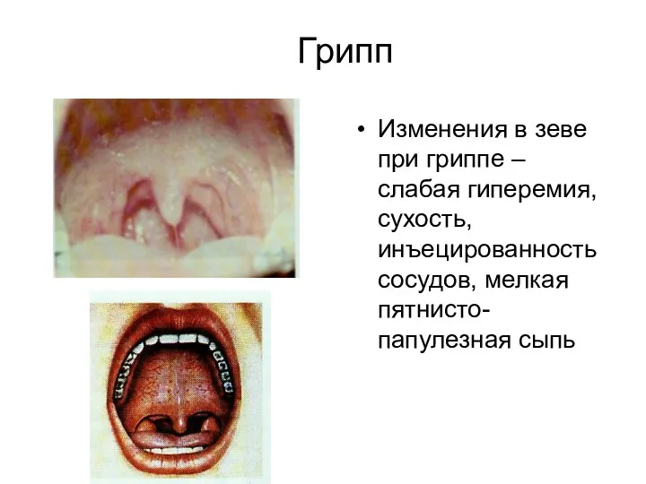 Грипп Изменения в зеве при гриппе – слабая гиперемия, сухость, инъецированность сосудов, мелкая пятнисто-папулезная сыпь