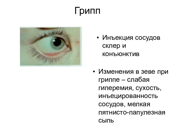 Грипп Инъекция сосудов склер и конъюнктив Изменения в зеве при