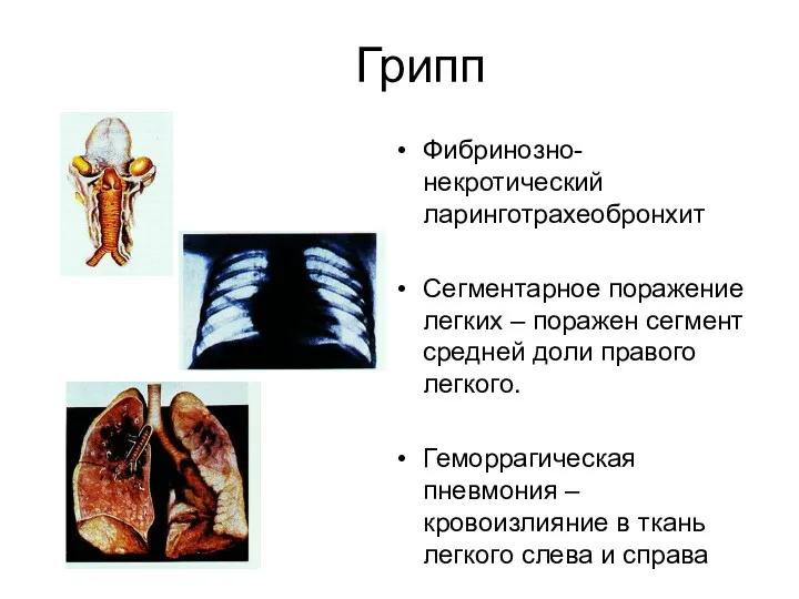 Грипп Фибринозно-некротический ларинготрахеобронхит Сегментарное поражение легких – поражен сегмент средней