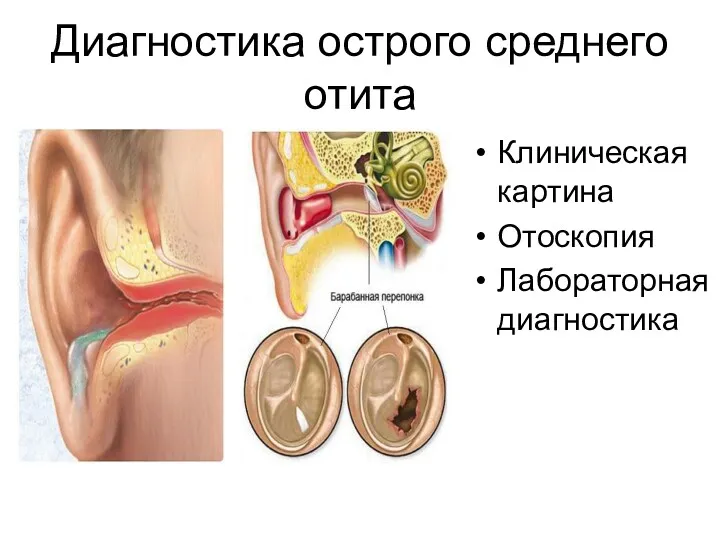 Диагностика острого среднего отита Клиническая картина Отоскопия Лабораторная диагностика