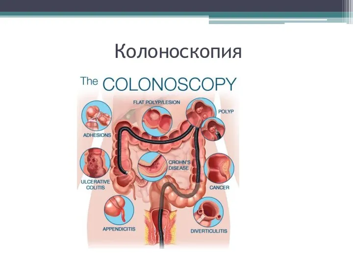 Колоноскопия