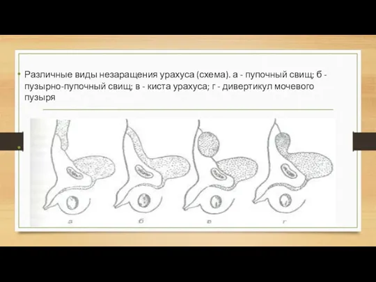 Различные виды незаращения урахуса (схема). а - пупочный свищ; б