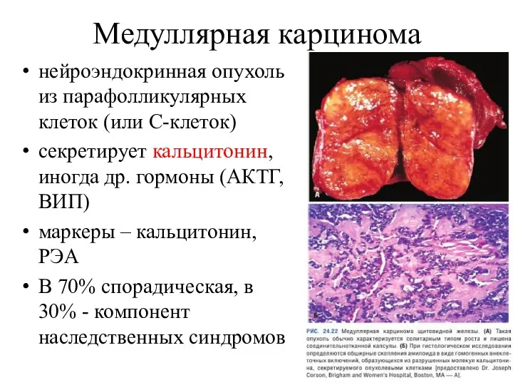 Медуллярная карцинома нейроэндокринная опухоль из парафолликулярных клеток (или С-клеток) секретирует