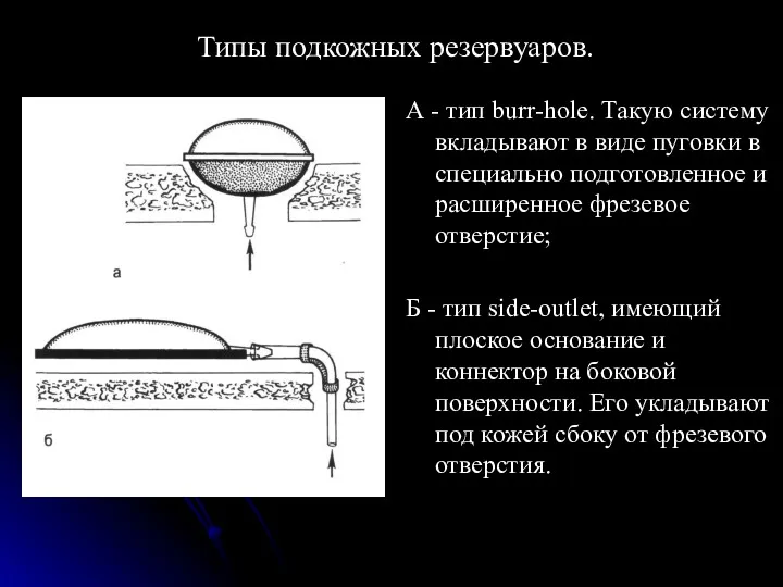 Типы подкожных резервуаров. А - тип burr-hole. Такую систему вкладывают