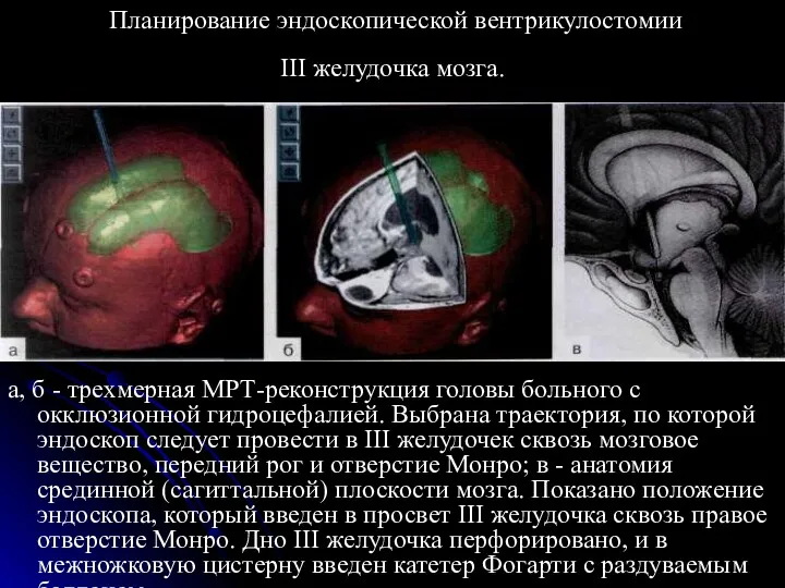 Планирование эндоскопической вентрикулостомии III желудочка мозга. а, б - трехмерная МРТ-реконструкция головы больного
