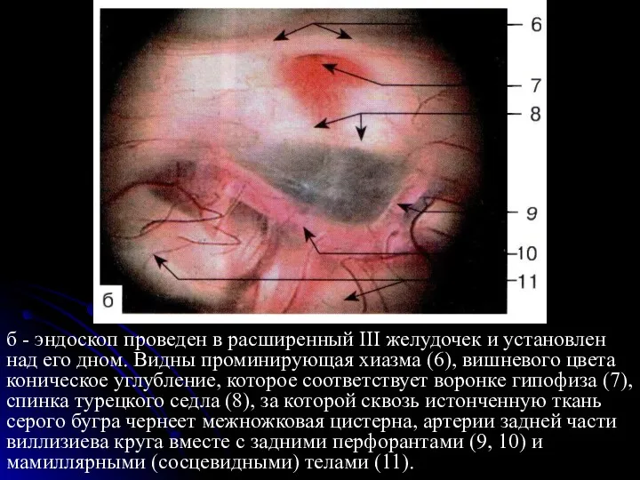 б - эндоскоп проведен в расширенный III желудочек и установлен над его дном.