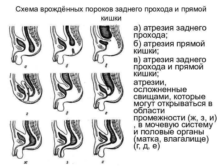 Схема врождённых пороков заднего прохода и прямой кишки а) атрезия