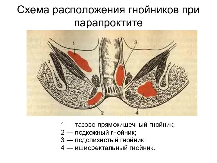 Схема расположения гнойников при парапроктите 1 — тазово-прямокишечный гнойник; 2