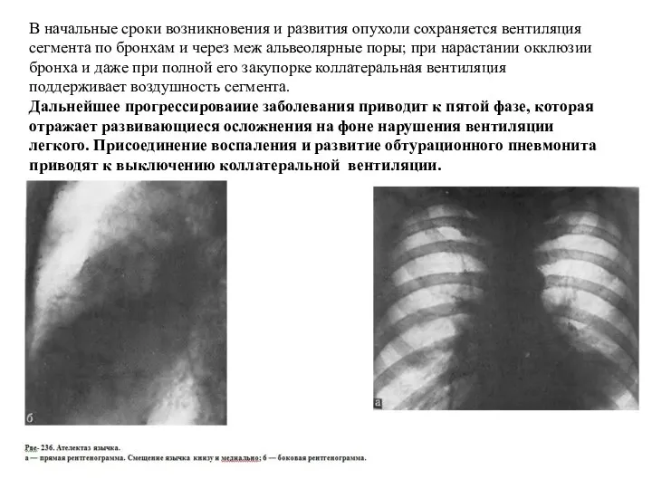 В начальные сроки возникновения и развития опухоли сохраняется вентиляция сегмента