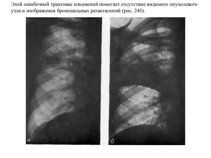 Этой ошибочной трактовке изменений помогает отсутствие видимого опухолевого узла и изображения бронхиальных разветвлепий (рис. 248).