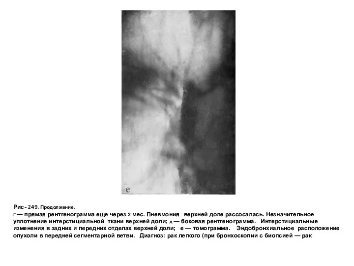 Рис- 249. Продолжение. Г — прямая рентгенограмма еще через 2