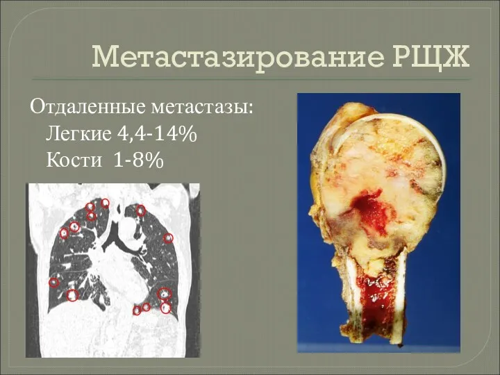 Метастазирование РЩЖ Отдаленные метастазы: Легкие 4,4-14% Кости 1-8%