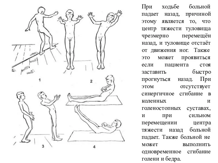 При ходьбе больной падает назад, причиной этому является то, что центр тяжести туловища