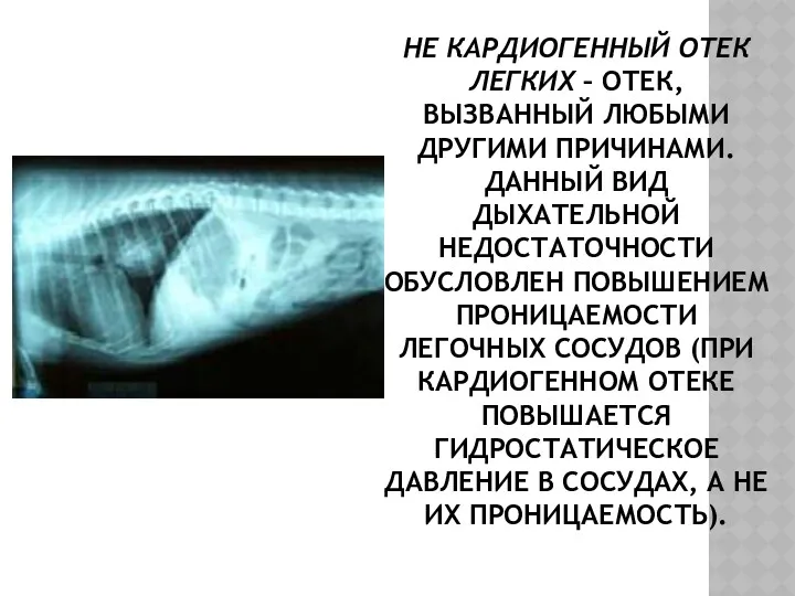 НЕ КАРДИОГЕННЫЙ ОТЕК ЛЕГКИХ – ОТЕК, ВЫЗВАННЫЙ ЛЮБЫМИ ДРУГИМИ ПРИЧИНАМИ.