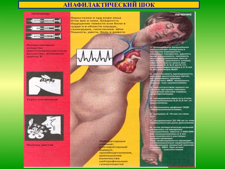 АНАФИЛАКТИЧЕСКИЙ ШОК