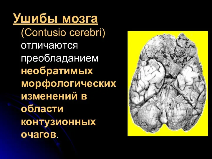 Ушибы мозга (Contusio cerebri) отличаются преобладанием необратимых морфологических изменений в области контузионных очагов.