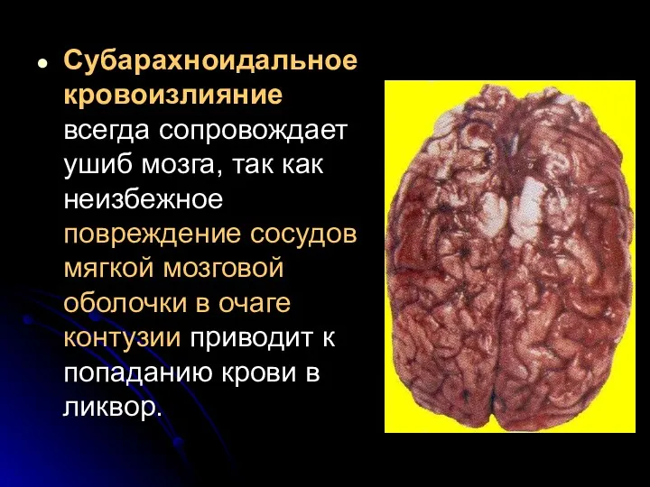 Субарахноидальное кровоизлияние всегда сопровождает ушиб мозга, так как неизбежное повреждение