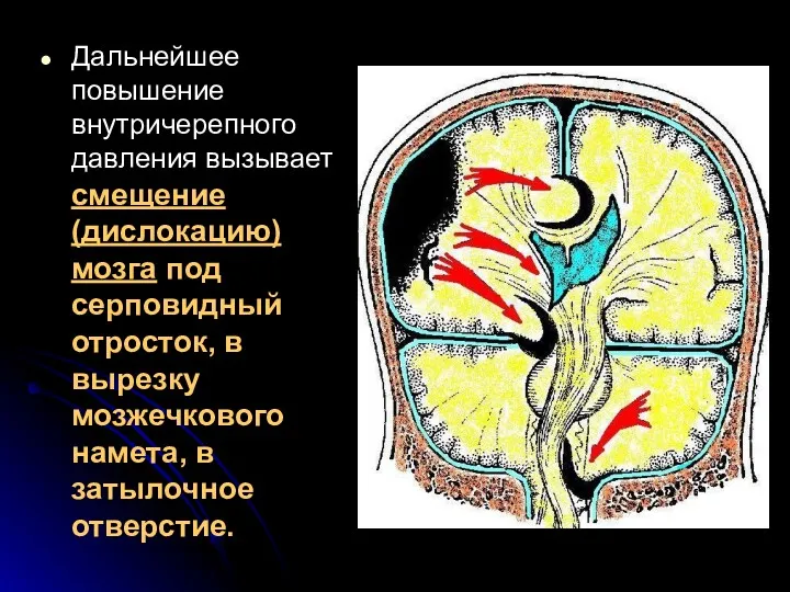 Дальнейшее повышение внутричерепного давления вызывает смещение (дислокацию) мозга под серповидный