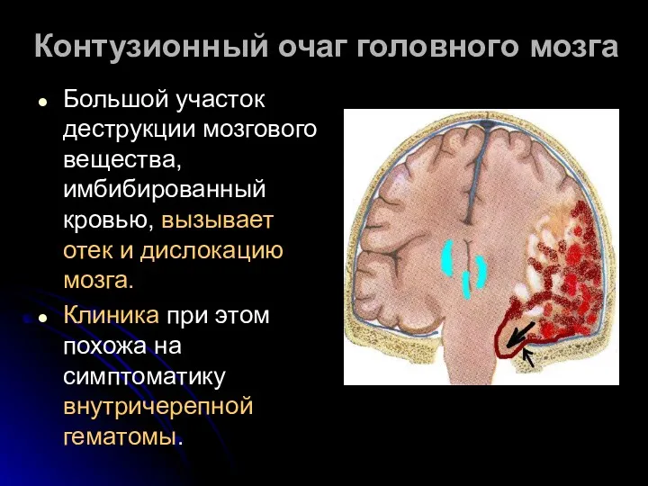 Контузионный очаг головного мозга Большой участок деструкции мозгового вещества, имбибированный