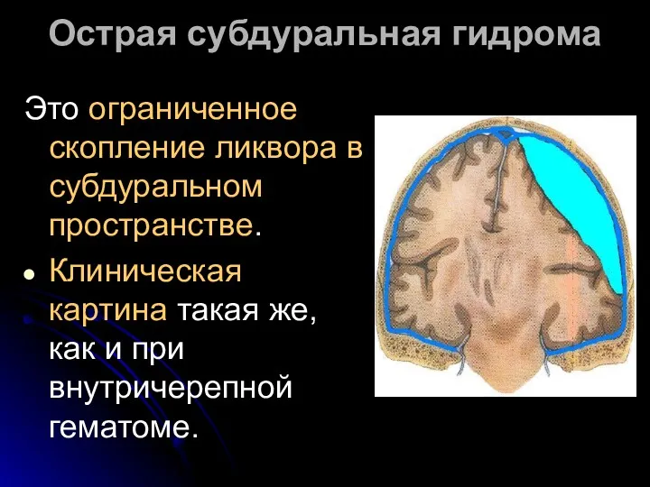 Острая субдуральная гидрома Это ограниченное скопление ликвора в субдуральном пространстве.