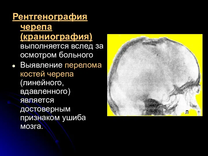 Рентгенография черепа (краниография) выполняется вслед за осмотром больного Выявление перелома