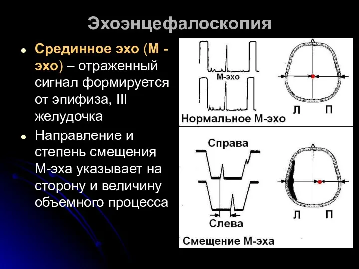 Эхоэнцефалоскопия Срединное эхо (М - эхо) – отраженный сигнал формируется