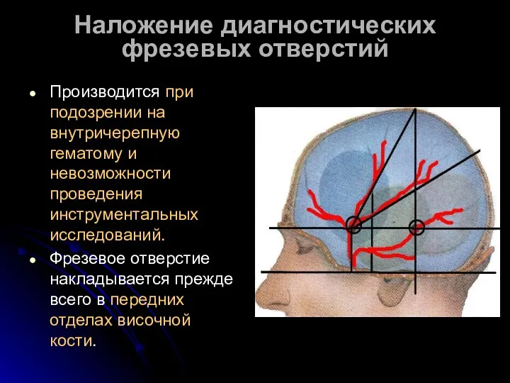 Наложение диагностических фрезевых отверстий Производится при подозрении на внутричерепную гематому