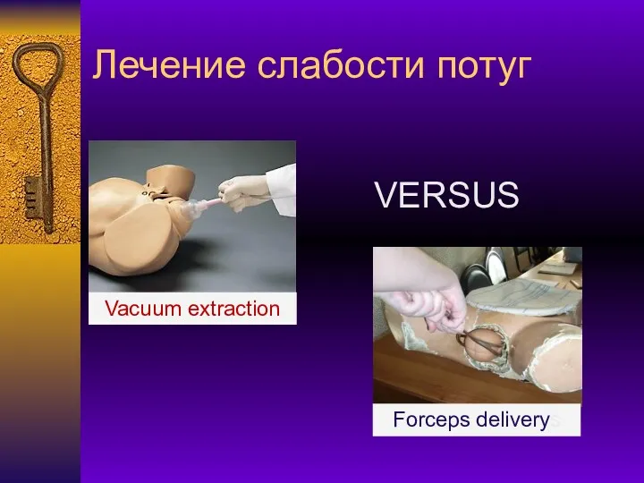 Лечение слабости потуг VERSUS Vacuum extraction Forceps deliverys