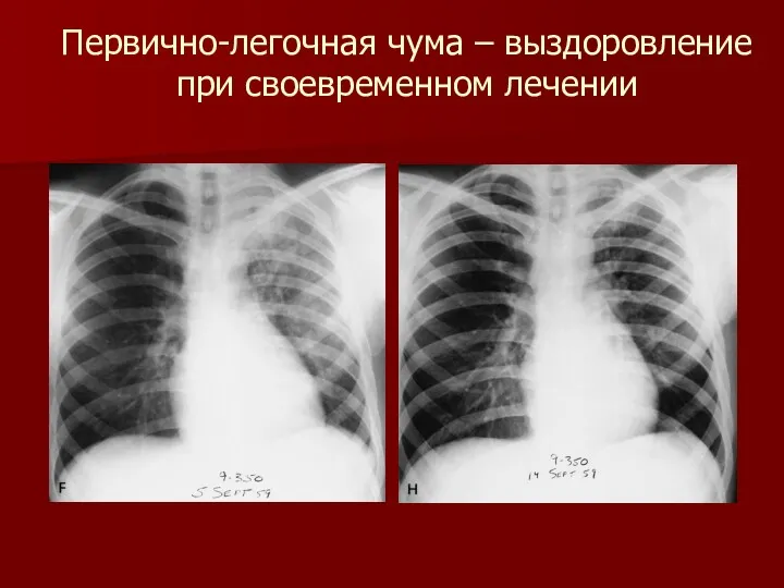 Первично-легочная чума – выздоровление при своевременном лечении