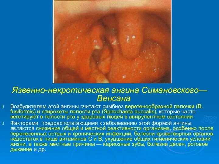 Язвенно-некротическая ангина Симановского—Венсана Возбудителем этой ангины считают симбиоз веретенообразной палочки (В. fusiformis) и