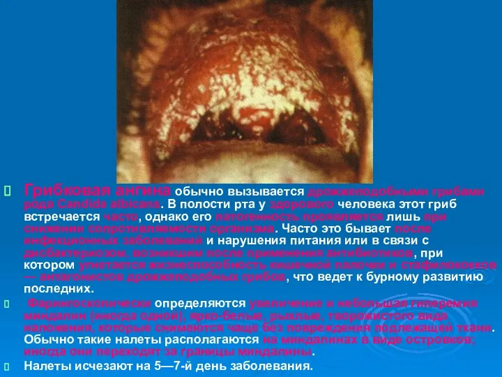 Грибковая ангина обычно вызывается дрожжеподобными грибами рода Candida albicans. В полости рта у