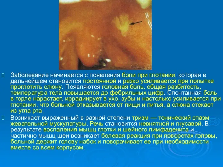 Заболевание начинается с появления боли при глотании, которая в дальнейшем