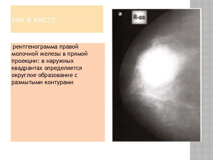 РАК В КИСТЕ. рентгенограмма правой молочной железы в прямой проекции: в наружных квадрантах