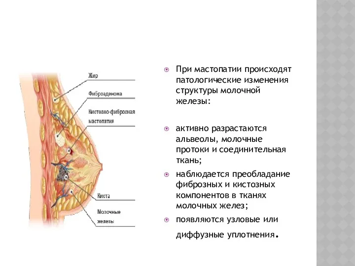 При мастопатии происходят патологические изменения структуры молочной железы: активно разрастаются альвеолы, молочные протоки