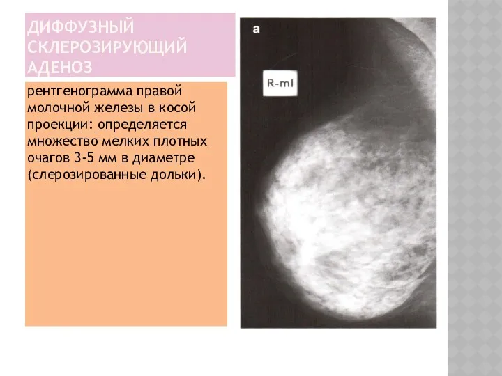 ДИФФУЗНЫЙ СКЛЕРОЗИРУЮЩИЙ АДЕНОЗ рентгенограмма правой молочной железы в косой проекции: определяется множество мелких