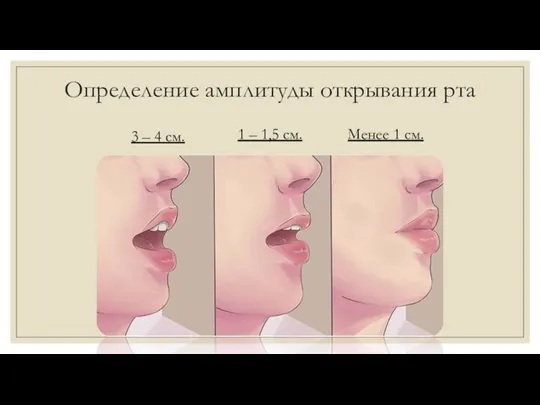 Определение амплитуды открывания рта 3 – 4 см. 1 – 1,5 см. Менее 1 см.