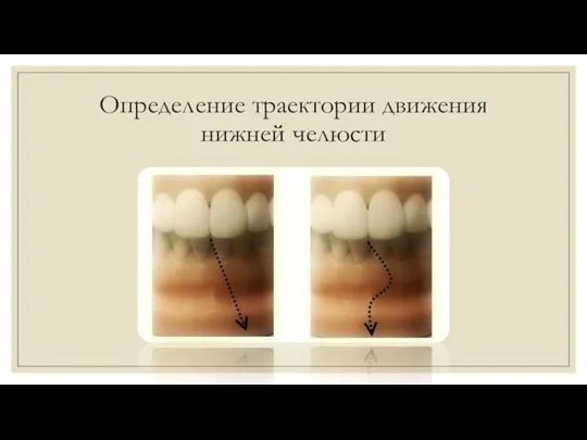 Определение траектории движения нижней челюсти