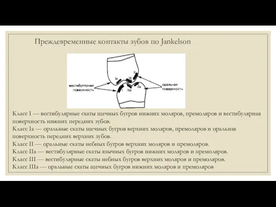 Преждевременные контакты зубов по Jankelson Класс I — вестибулярные скаты щечных бугров нижних