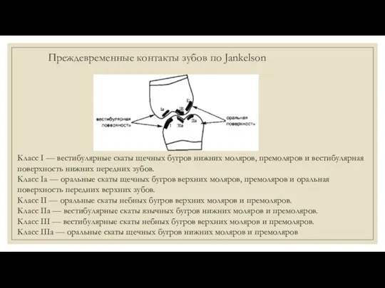 Преждевременные контакты зубов по Jankelson Класс I — вестибулярные скаты