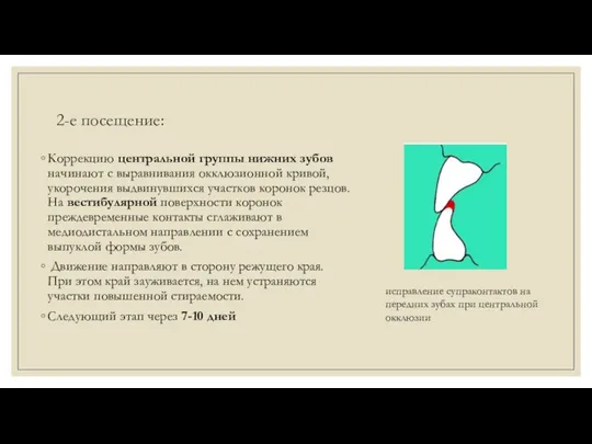 2-е посещение: Коррекцию центральной группы нижних зубов начинают с выравнивания окклюзионной кривой, укорочения