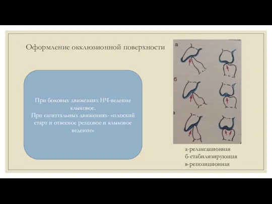 Оформление окклюзионной поверхности При боковых движениях НЧ-ведение клыковое. При сагиттальных движениях- «плоский старт