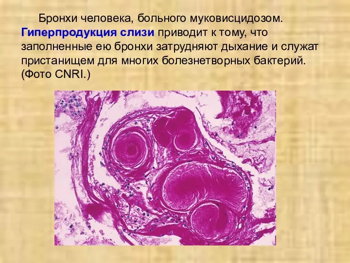 Бронхи человека, больного муковисцидозом. Гиперпродукция слизи приводит к тому, что