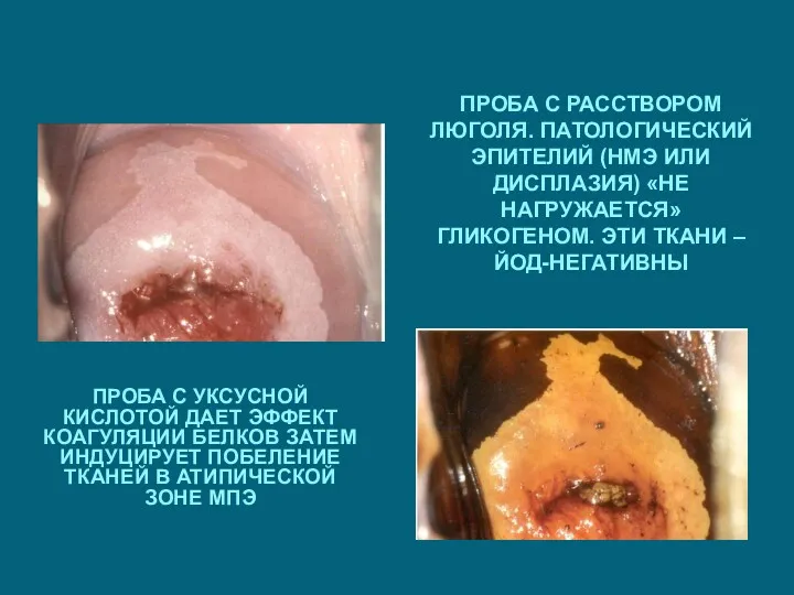 ПРОБА С УКСУСНОЙ КИСЛОТОЙ ДАЕТ ЭФФЕКТ КОАГУЛЯЦИИ БЕЛКОВ ЗАТЕМ ИНДУЦИРУЕТ