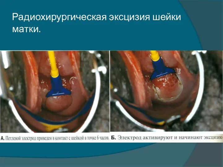 Радиохирургическая эксцизия шейки матки.