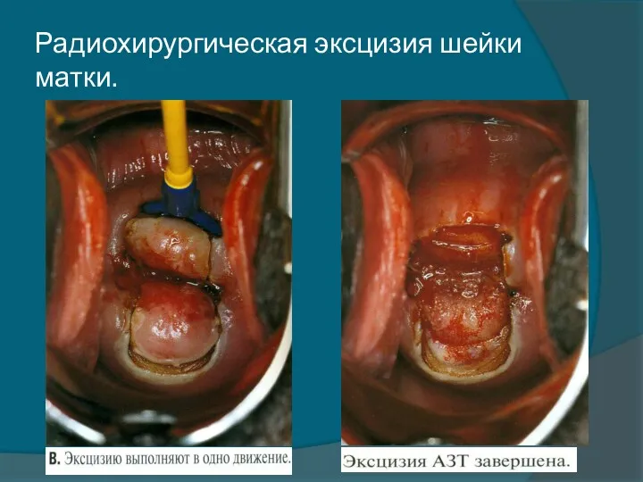 Радиохирургическая эксцизия шейки матки.