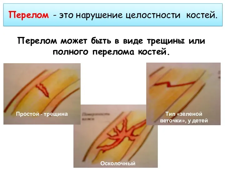 Перелом - это нарушение целостности костей. Перелом может быть в