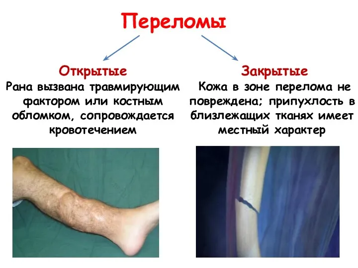 Открытые Рана вызвана травмирующим фактором или костным обломком, сопровождается кровотечением