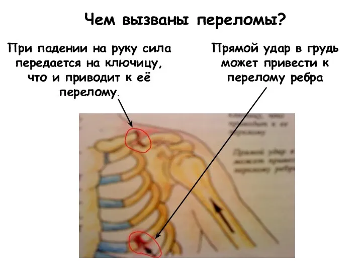 Чем вызваны переломы? При падении на руку сила передается на